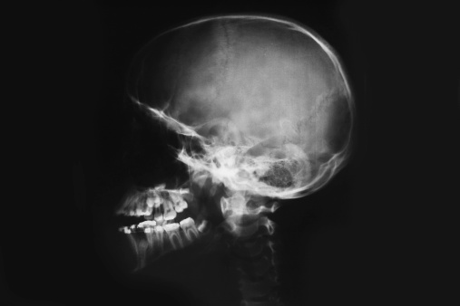 X-ray of the cranium