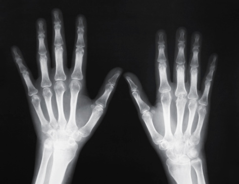 X-ray of human wrist
