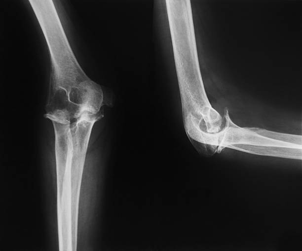 X-ray image of elbow...person with rheumatoid arthritis