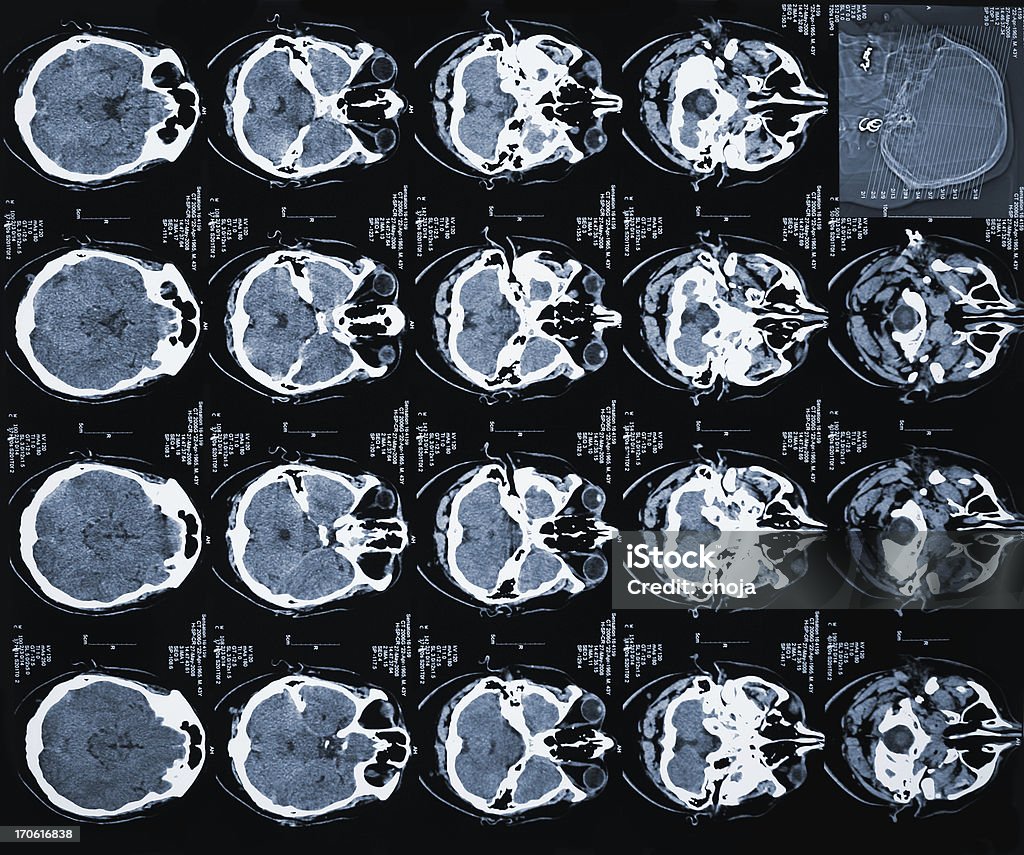 TAC di testa umana - Foto stock royalty-free di Tomografia computerizzata