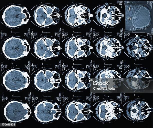 Tac Di Testa Umana - Fotografie stock e altre immagini di Tomografia computerizzata - Tomografia computerizzata, Apparecchiatura per la TAC, Apparecchiatura medica