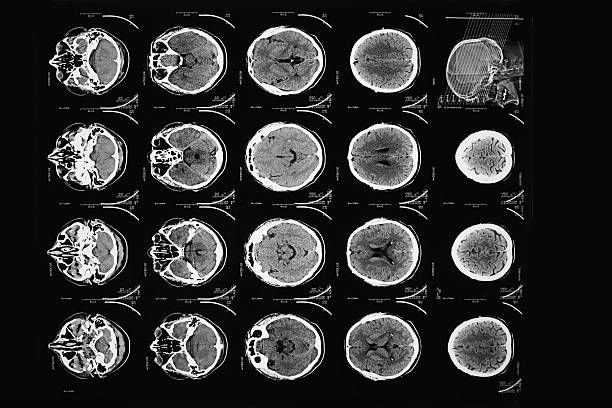 x_ray immagine del cervello umano - mri scan cat scan machine x ray brain foto e immagini stock