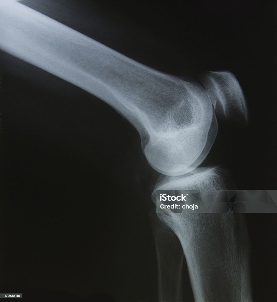 X-레이 인간 knee.side 보기 - 로열티 프리 X-레이 스톡 사진