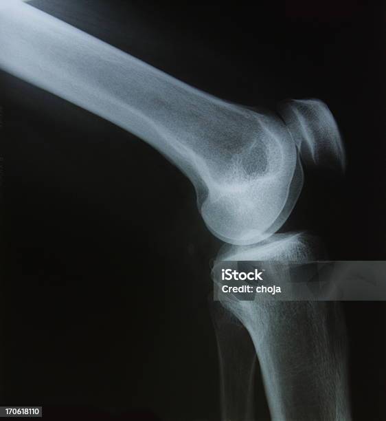 X레이 인간 Kneeside 보기 X-레이에 대한 스톡 사진 및 기타 이미지 - X-레이, 건강 진단, 건강관리와 의술