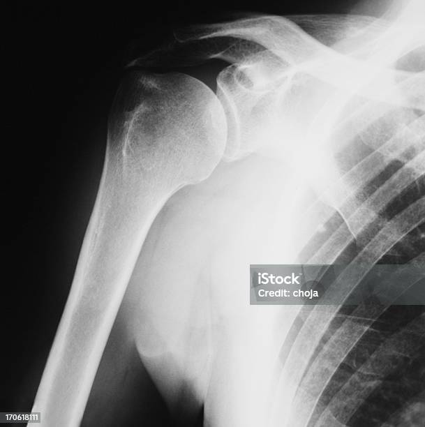Xray Der Schulter Stockfoto und mehr Bilder von Atemübung - Atemübung, Brustbereich, Brustkorb - Menschlicher Knochen