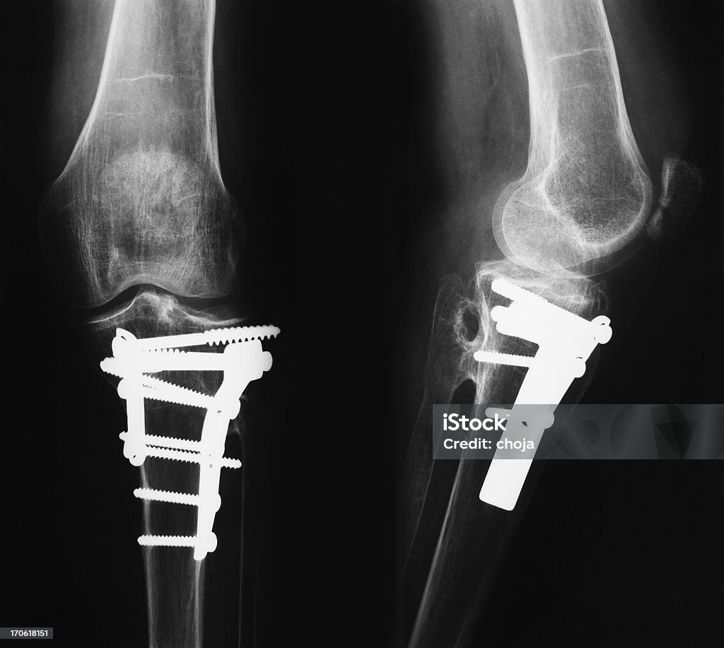 Imagen de rayos X de rotura piernas con osteosynthetic material - Foto de stock de Imagen de rayos X libre de derechos
