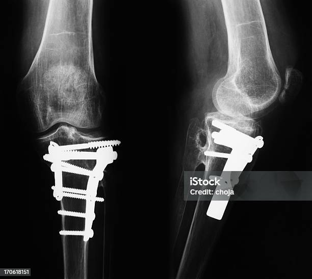 Zdjęcie Rentgenowskie Uszkodzonych Nogi Z Osteosynthetic Materiału - zdjęcia stockowe i więcej obrazów Zdjęcie rentgenowskie