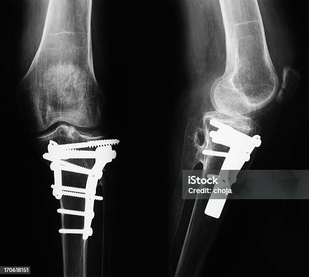 Foto de Imagem De Raios X De Broken Pernas Com Material Osteosynthetic e mais fotos de stock de Imagem de raios X