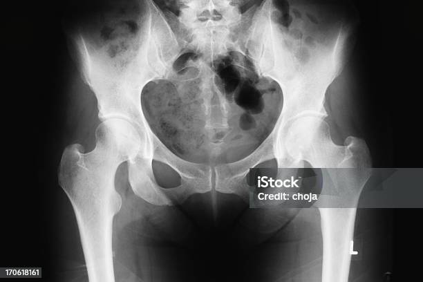 X선 영상 엉덩관절에 대한 스톡 사진 및 기타 이미지 - 엉덩관절, 엑스레이 이미지, X-레이