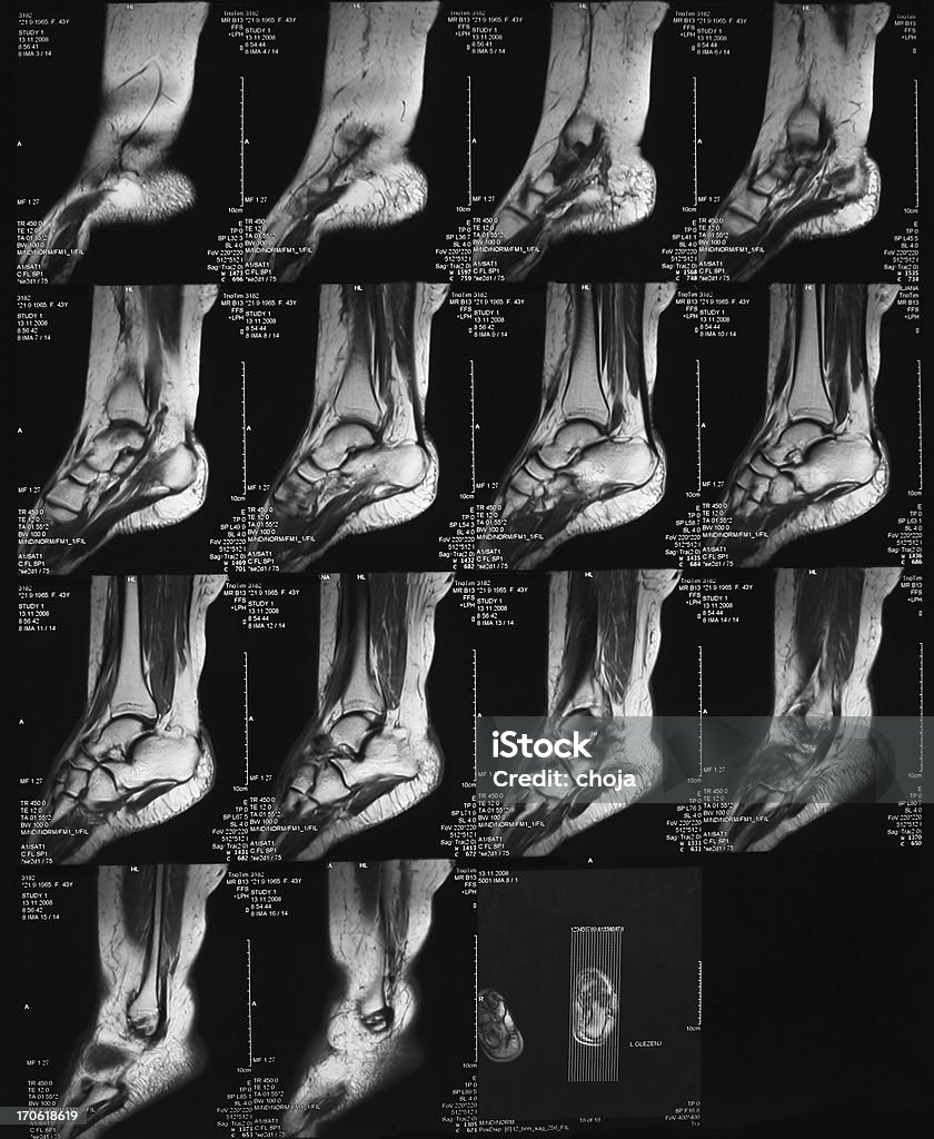 MRI scan des menschlichen Fußes - Lizenzfrei Röntgenbild Stock-Foto