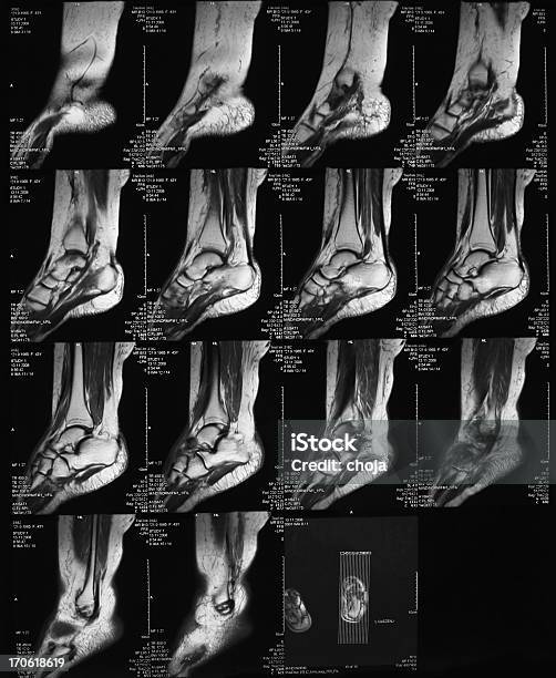 Mri Scan Des Menschlichen Fußes Stockfoto und mehr Bilder von Röntgenbild - Röntgenbild, Menschlicher Fuß, Medizinisches Röntgenbild