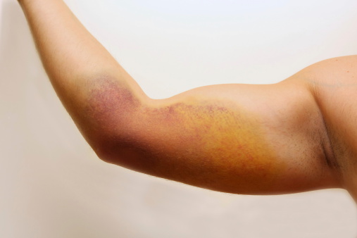 Young man's arm after accident...bruises