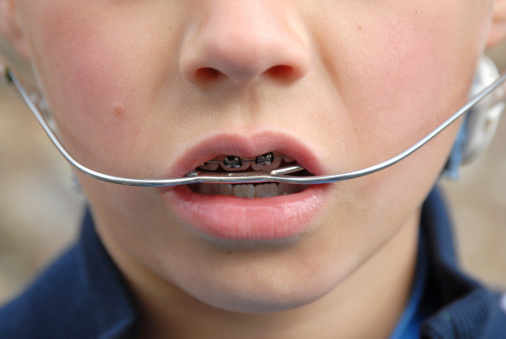 Close up of young boy with orthodontic appliance; neck gear and braces; just showing mouth andappliance with braces.