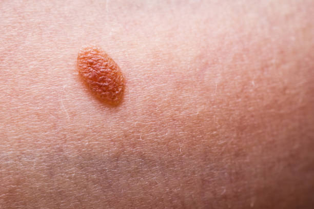 istock Closeup brown mole on caucasian woman skin. 1706769873