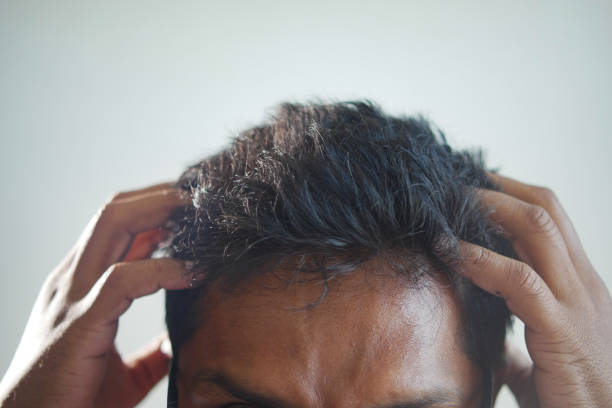 istock men with dandruff in his hair, closeup 1707657988