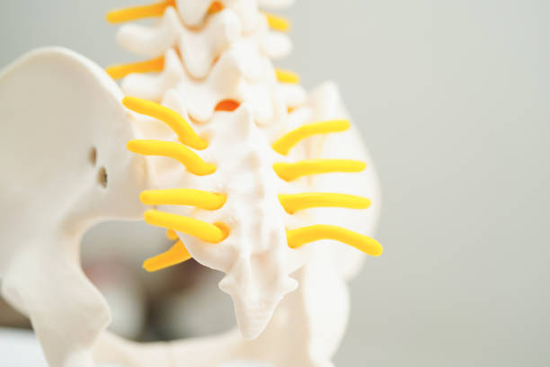 istock Spinal nerve and bone, Lumbar spine displaced herniated disc fragment, Model for treatment medical in the orthopedic department. 1708019414