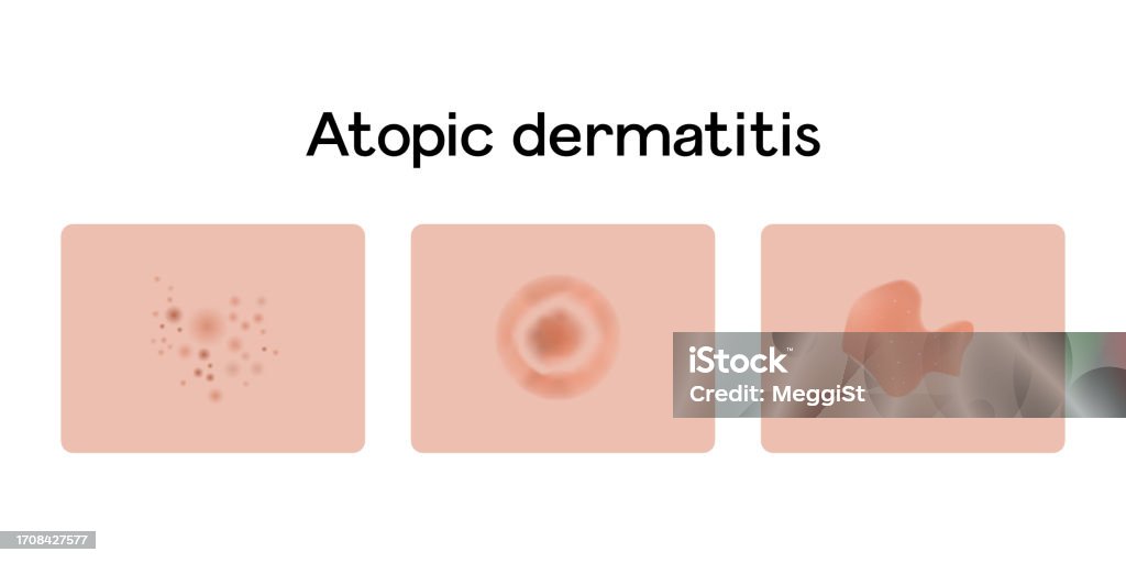 Dermatitis Problem Atopic Dermatitis Examples Vector Illustration Design Medical Problems ...