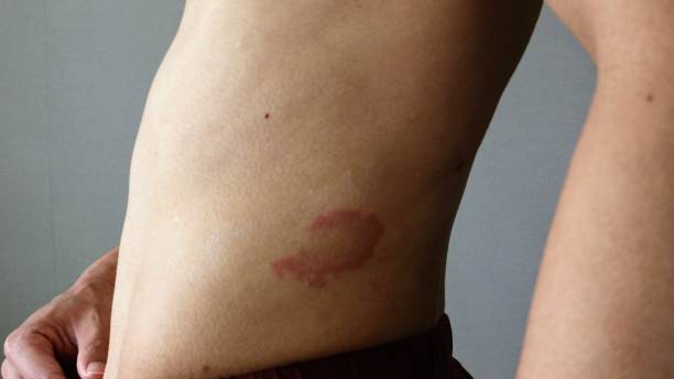istock A person with eczema on his abdomen 1709451676