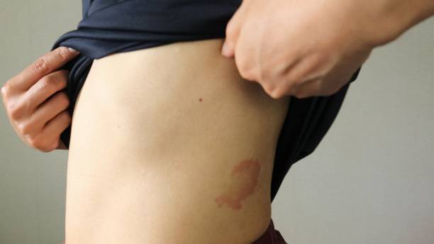 istock A person with eczema on his abdomen 1709454958