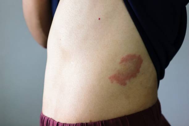 istock A person with eczema on his abdomen 1709455548