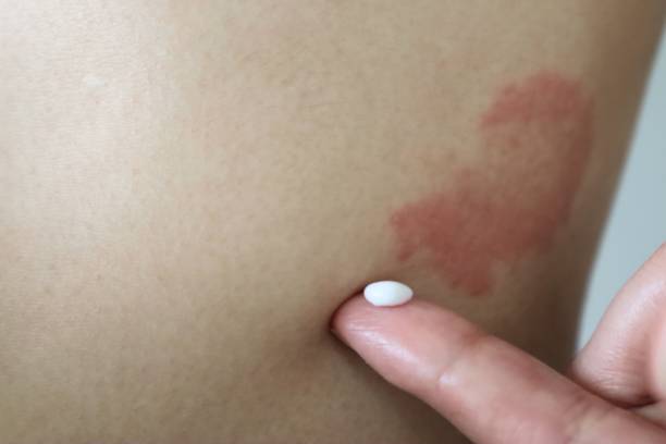 istock A person applying medicine to eczema 1709459904