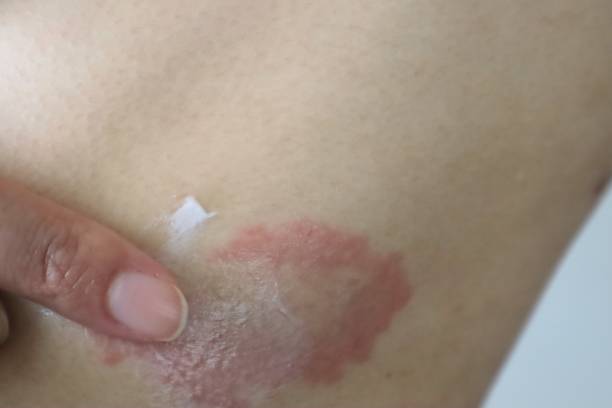 istock A person applying medicine to eczema 1709462099