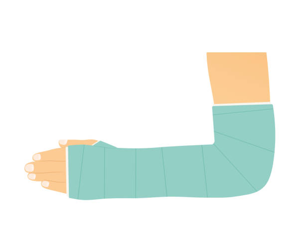 broken arm with plaster broken arm with plaster- vector illustration bandage arm stock illustrations