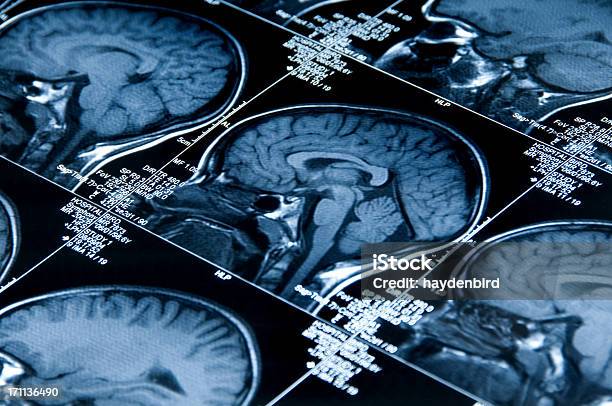 Scansione Rm Cerebrale Con Più Immagini Di Testa E Teschio - Fotografie stock e altre immagini di RMN