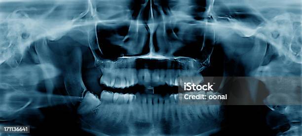 Foto de Xray Dentário e mais fotos de stock de Imagem de raios X - Imagem de raios X, Raio X, Saúde dental