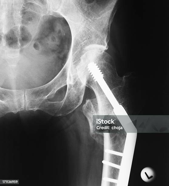 Fractura Da Anca - Fotografias de stock e mais imagens de Fratura - Fratura, Fémur, Osso Humano