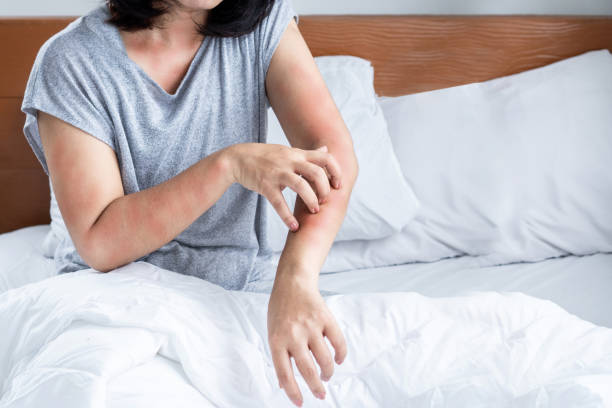 woman have problem with dust mites allergy bedding hand scratching rash skin
