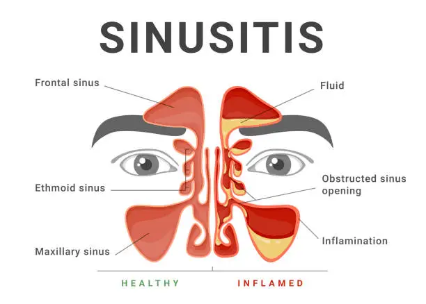 Vector illustration of Sinusitis healthy and inflammatory educational medical infographic scheme banner vector flat