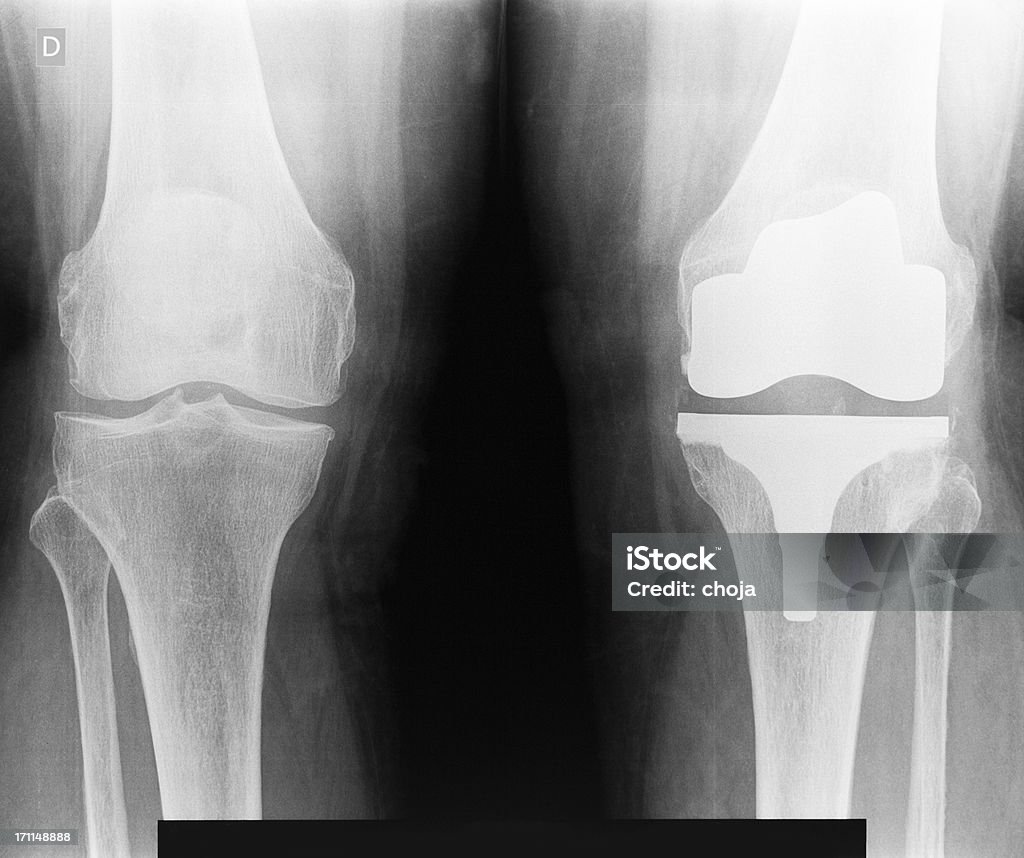 Imagen de rayos X de la rodilla artificial - Foto de stock de Rodilla artificial libre de derechos