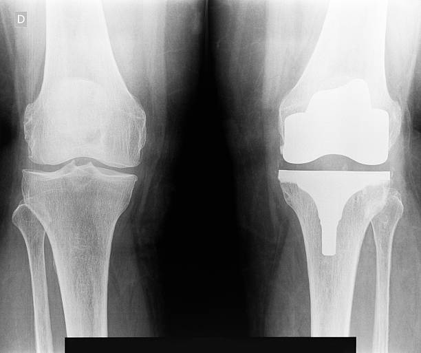 X-ray image of artificial knee X-ray image of artificial left knee....knee replacement artificial knee photos stock pictures, royalty-free photos & images