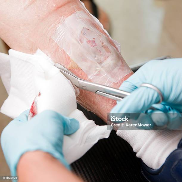 Madetherapie Stockfoto und mehr Bilder von Wunde - Wunde, Fürsorglichkeit, Made