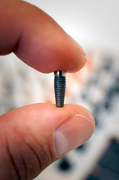 istock Dental implant 171156610