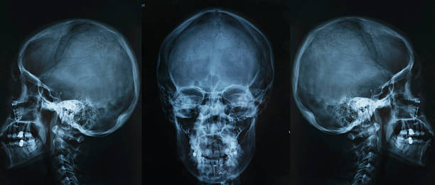 x-ray di teschio - unknown gender foto e immagini stock