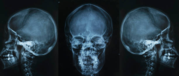 X-Ray Of Skull Brain x-ray film. unknown gender stock pictures, royalty-free photos & images