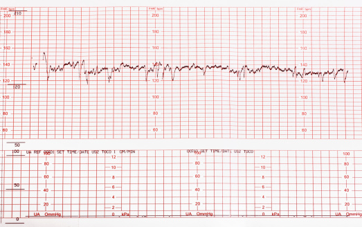 Graph showing the results of the electrocardiogram (EKG) test on recording paper.