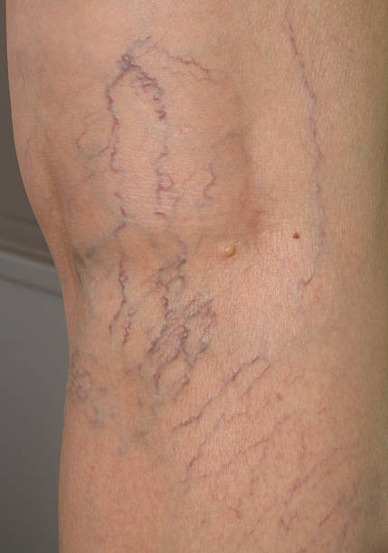 Human Spider Veins on Leg Closeup A close-up view of spider veins on a woman's leg taken from behind the knee. spider veins stock pictures, royalty-free photos & images