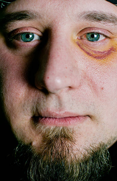 istock Man with black eye injury 171251776