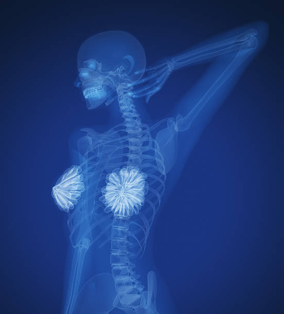 istock X-Ray showing woman's breast cancer 171258246
