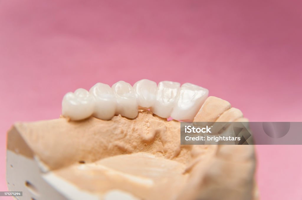 Prótese dentária - Royalty-free Artificial Foto de stock