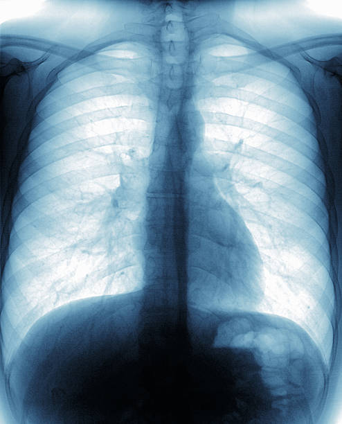 x-ray bilder von gesunden cheat - libs stock-fotos und bilder