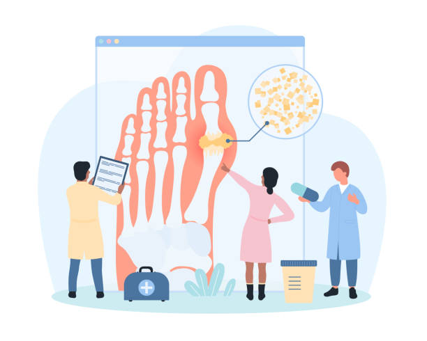 Diagnosis of gout, tiny people study infographic foot medical diagram to diagnose Diagnosis of gout vector illustration. Cartoon tiny people study infographic foot medical diagram, doctors diagnose arthritis inflammation and pain in joint articulation due to uric acid crystals big feet cartoon stock illustrations