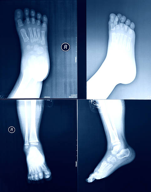 imagerie par rayons x des pieds. - bending human foot ankle x ray image photos et images de collection