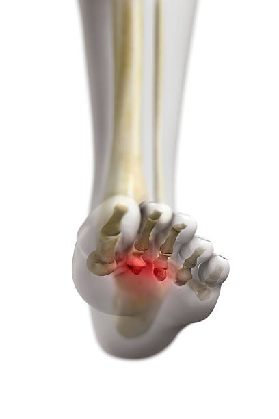 morton "s neuroma - ishealth2012 zdjęcia i obrazy z banku zdjęć