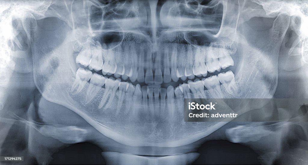 Radiografía dental PANORÁMICA - Foto de stock de Imagen de rayos X libre de derechos