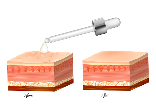 Realistic vector illustration with Healthy and damaged skin. Hydrated and dry skin. Cross section of a skin layers epidermis and dermis. Care rejuvenation of the skin.