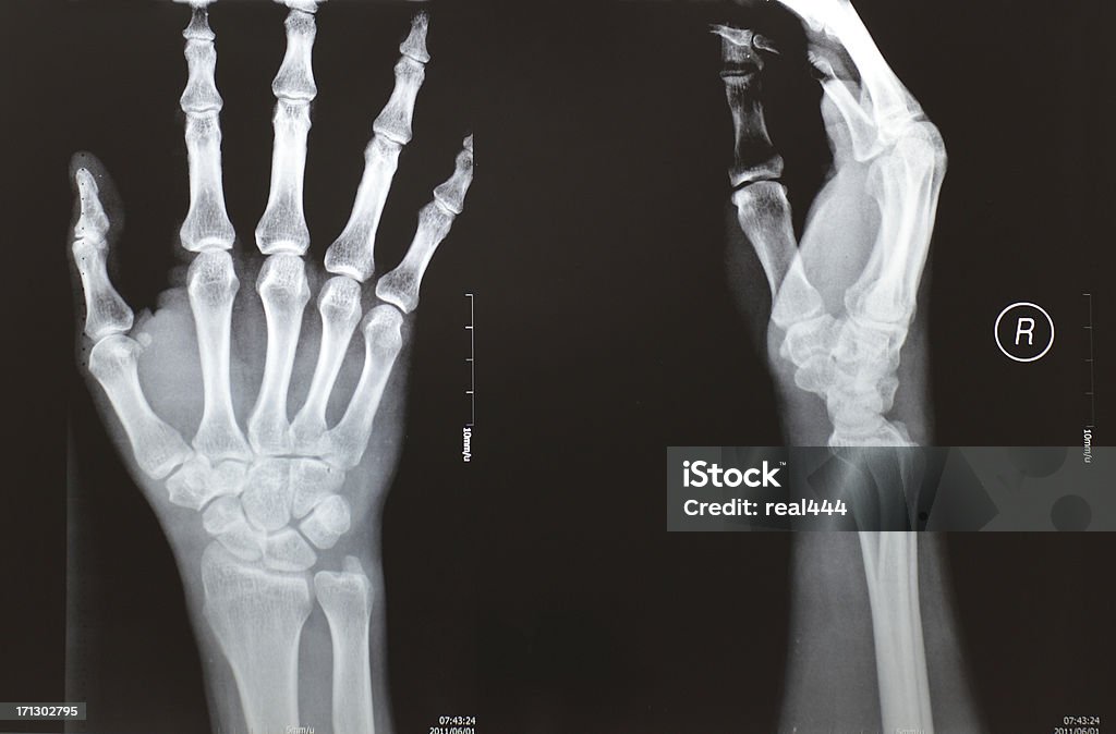 Рентгеновское изображение руки - Стоковые фото Рентгеновский снимок роялти-фри
